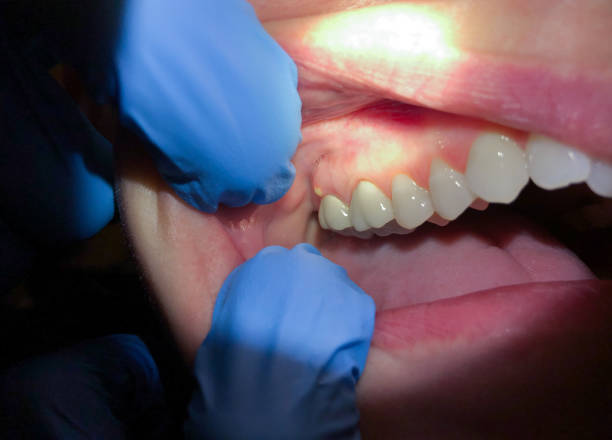 Best Emergency Denture Repair in Princeton, MN