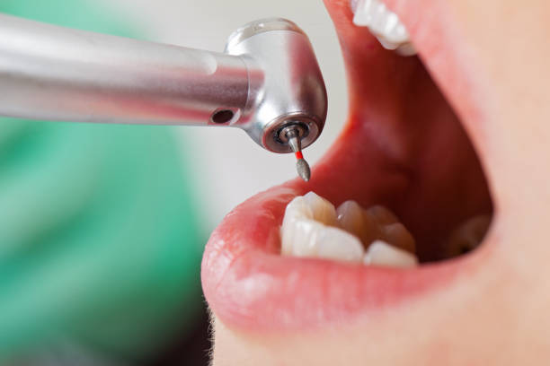 Best Dental Abscess Treatment in Princeton, MN